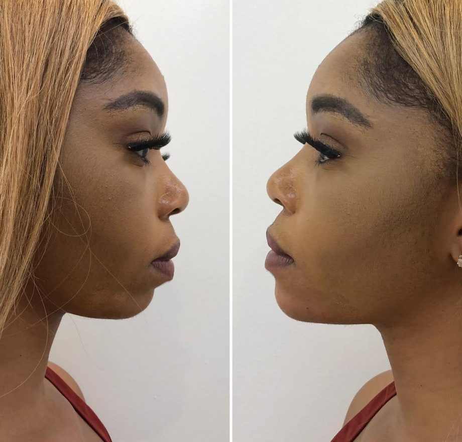 Kim Kholiwe undergoes a succesful Non-Surgical Chin Augmentation in Beverly Hills